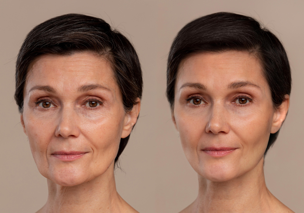 Mesotherapy Before and After and What to Expect from the Procedure